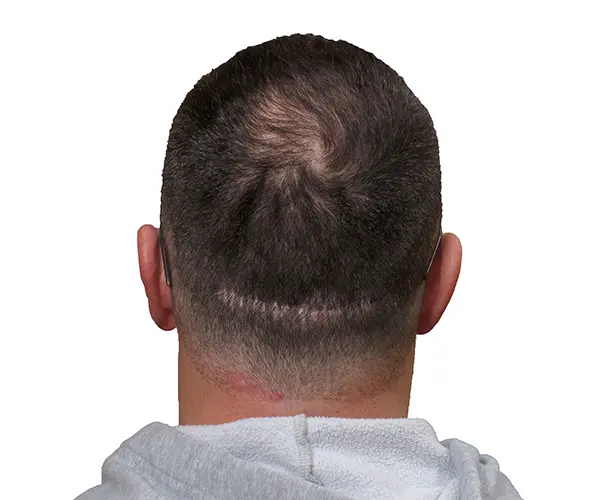 Alopecia en coronilla masculina antes de tratamiento de micropigmentación efecto densidad en Barcelona