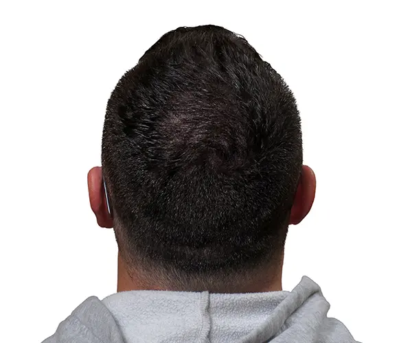 Resultado de micropigmentación efecto densidad en coronilla y zona posterior masculina en Barcelona