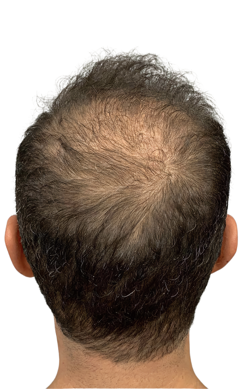 Alopecia en coronilla masculina antes de tratamiento de micropigmentación efecto densidad en Barcelona
