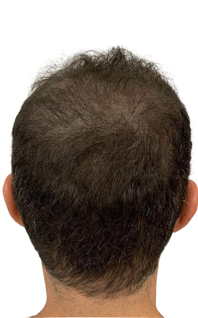 Efecto densidad en coronilla y zona posterior masculina por ScalpMicroBCN en Barcelona