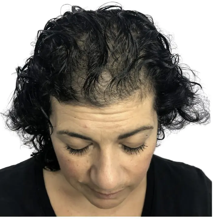 Alopecia difusa en cabello rizado femenino antes de micropigmentación efecto densidad por ScalpMicroBCN en Barcelona
