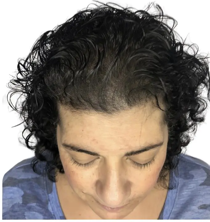 Densificación capilar en pelo rizado femenino por ScalpMicroBCN en Barcelona