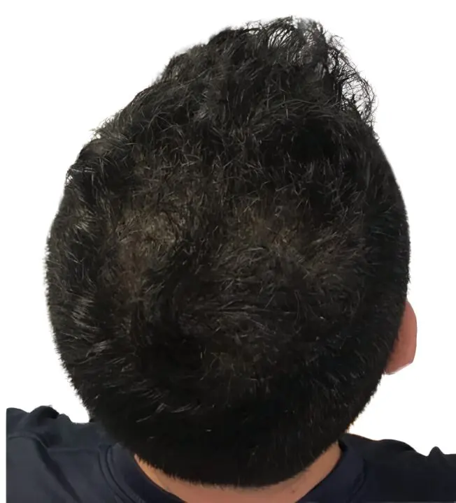 Resultado de micropigmentación efecto densidad en coronilla masculina por ScalpMicroBCN en Barcelona