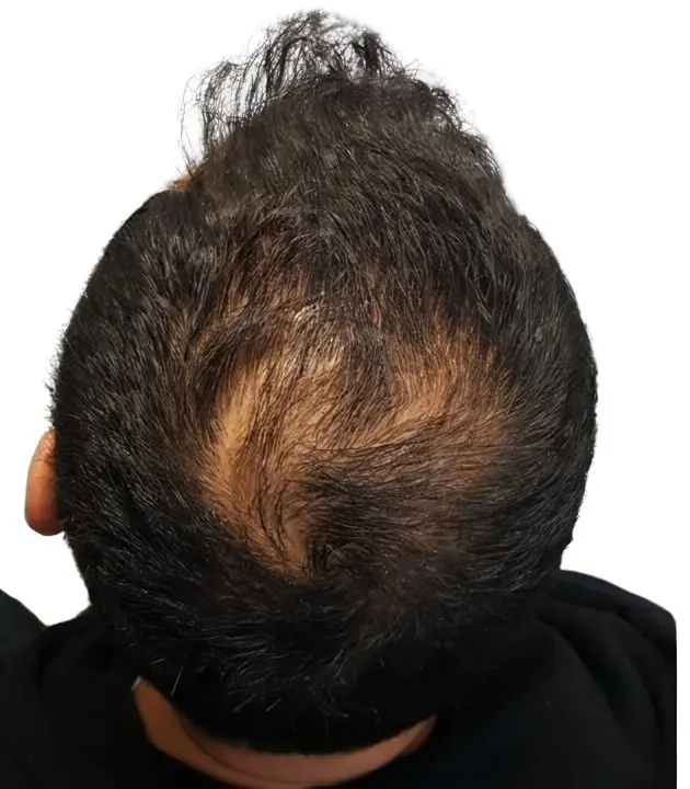 Clareamiento en coronilla y zona superior en hombre con pelo rizado antes de micropigmentación efecto densidad por ScalpMicroBCN en Barcelona