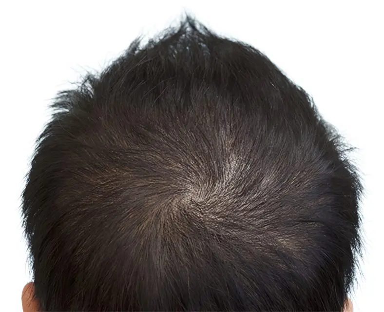 Clareamiento en coronilla masculina con cabello oscuro antes de micropigmentación efecto densidad por ScalpMicroBCN en Barcelona