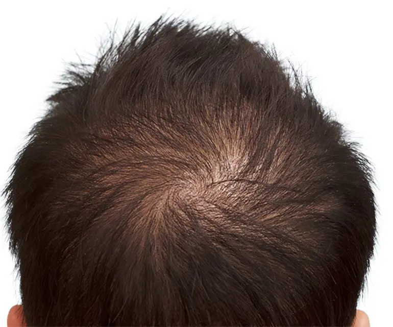 Efecto densidad en coronilla masculina con cabello oscuro por ScalpMicroBCN en Barcelona