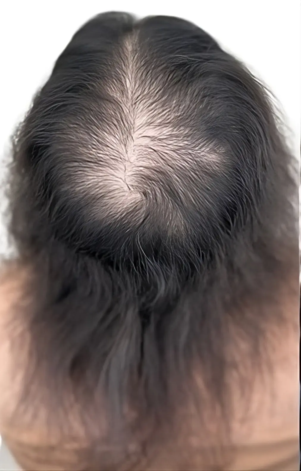 Alopecia difusa femenina en coronilla y raya central antes de micropigmentación efecto densidad en ScalpMicroBCN Barcelona