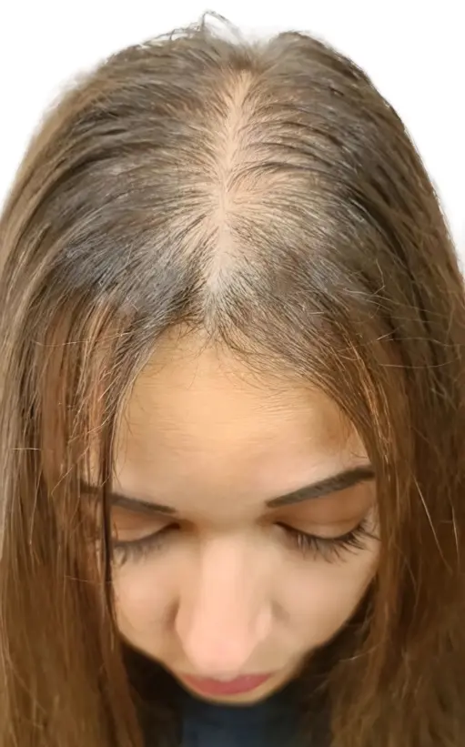 Alopecia difusa en raya frontal femenina antes de micropigmentación efecto densidad por ScalpMicroBCN en Barcelona