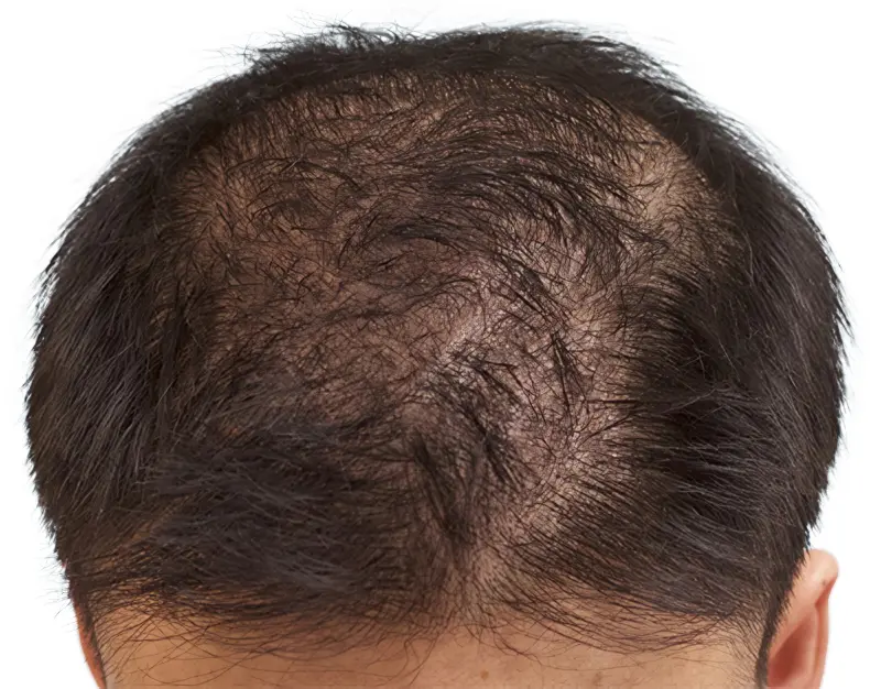 Micropigmentación efecto densidad para alopecia difusa masculina por ScalpMicroBCN en Barcelona