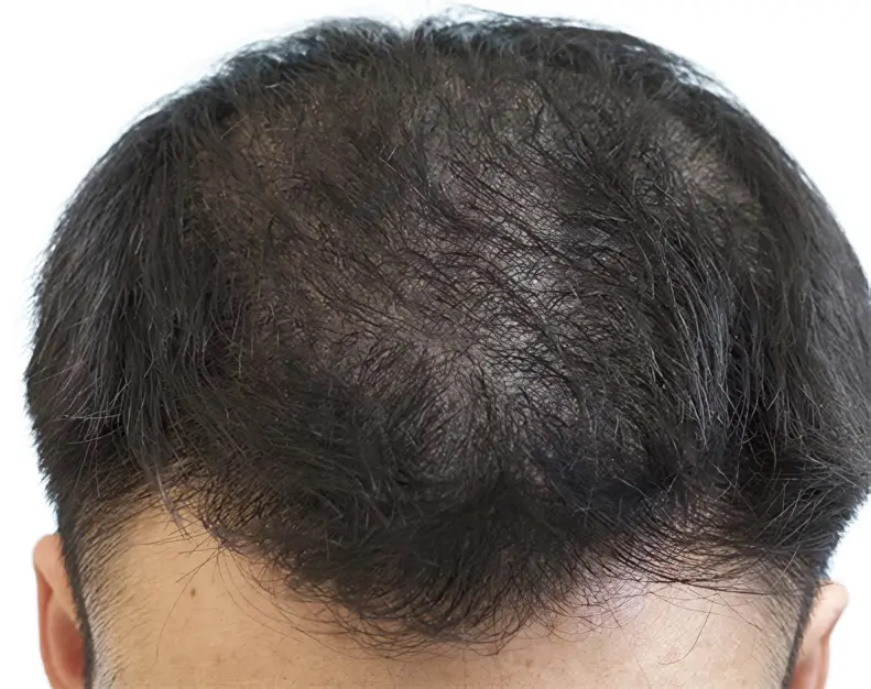 Micropigmentación efecto densidad en zona superior masculina por ScalpMicroBCN en Barcelona