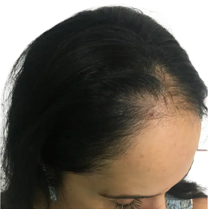 Tratamiento de densidad capilar en entradas y zona frontal para mujer por ScalpMicroBCN en Barcelona