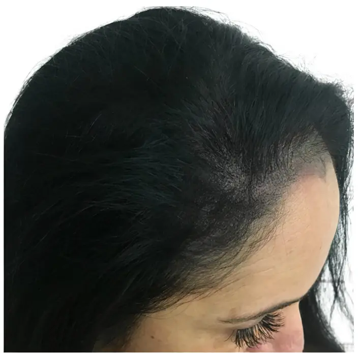 Micropigmentación efecto densidad en línea frontal y entradas femeninas por ScalpMicroBCN en Barcelona