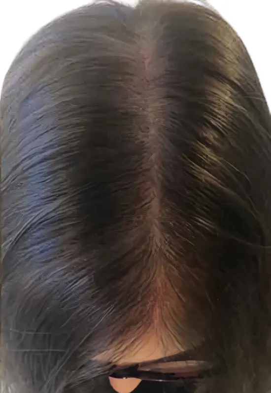 Micropigmentación efecto densidad en raya del pelo para mujer por ScalpMicroBCN en Barcelona
